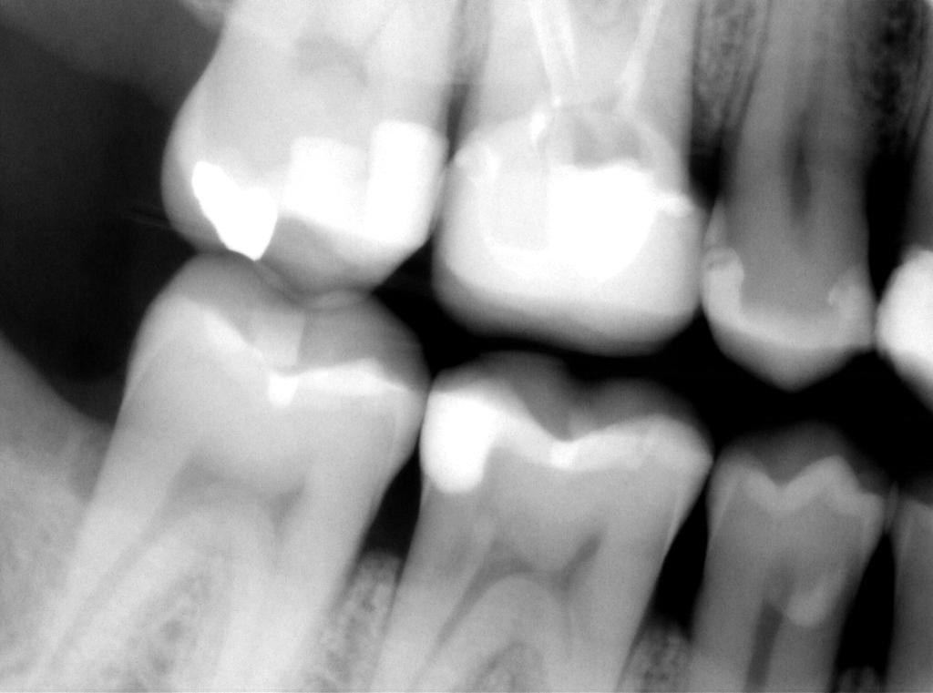Diagnostic Findings: Tooth # Prob Perc Palp Mob Cold 2 3 NT 4 Radiographic