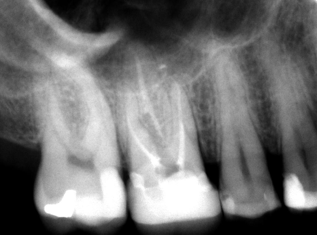 P, possible missed MB2, periapical tissues appear within normal limits, roots are in