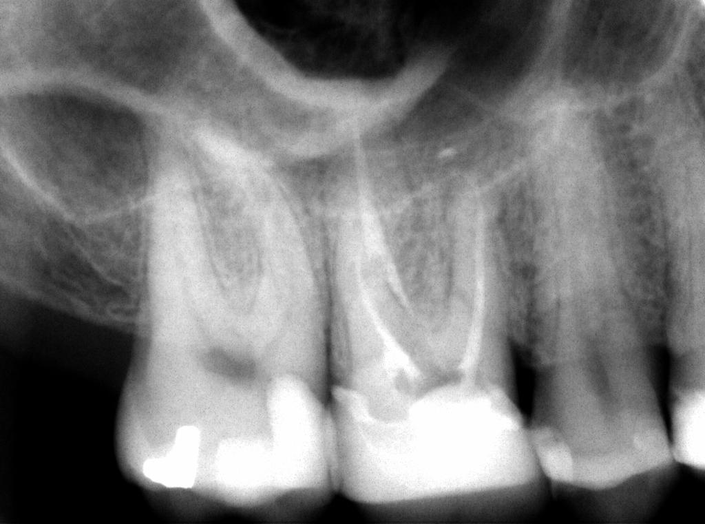 Pre-op films Assessment Pre-treatment diagnosis: #3 Previously treated with normal periapex Plan The recommended treatment plan was to attempt non-surgical root canal retreatment.