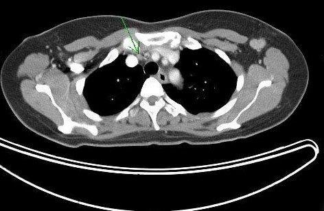 reconstruction. PET/CT showed a 6 mm mediastinal node (normal by CT criteria) which was FDG avid. Biopsy proved metastatic disease.