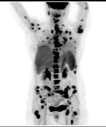 Figure 3 shows PET/CT imaging in a patient with bone only metastases at presentation and who had a good response to chemotherapy in her bone metastases.