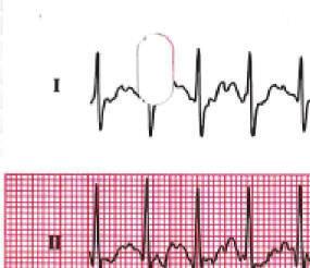 2 Case Reports in Medicine Figure 1: Electrocardiogram obtained during exercise