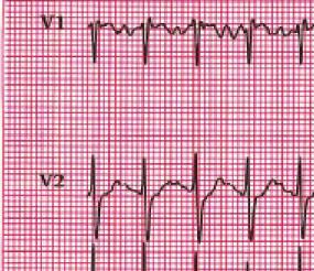 On CMR, a large SV-ASD was observed with severe right atrial and ventricular