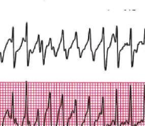 aberrant conduction and a ventricular rate of 290 bpm.