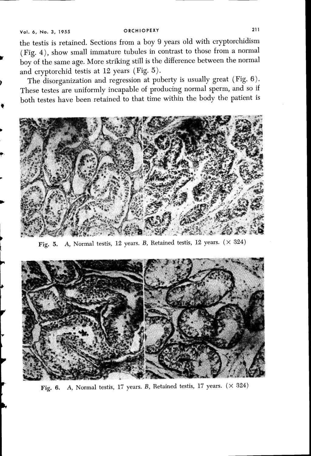 Vol. 6, No.3, 1955 ORCHIOPEXY 211 the testis is retained.