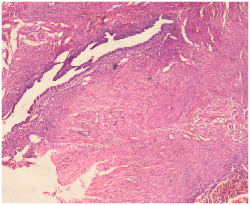 Age-Wise Distribution of Fallopian Tube Lesions Tubal Patholog y Salpingitis Ectopic tubal gestation Paratubal cyst Haematosalpin x Endometriosis Torsion Tumours Total -0-0 5 4-40 5 6 4-50 0 4 8 5
