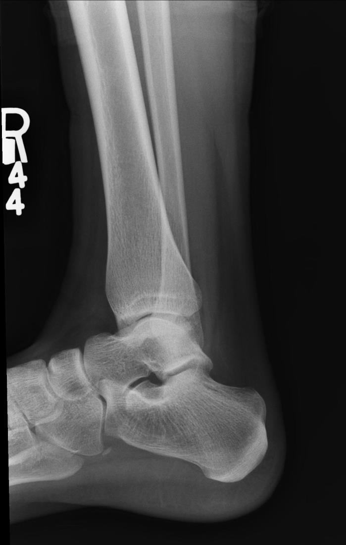 Lateral ankle Error; leg is rotated, the fibula