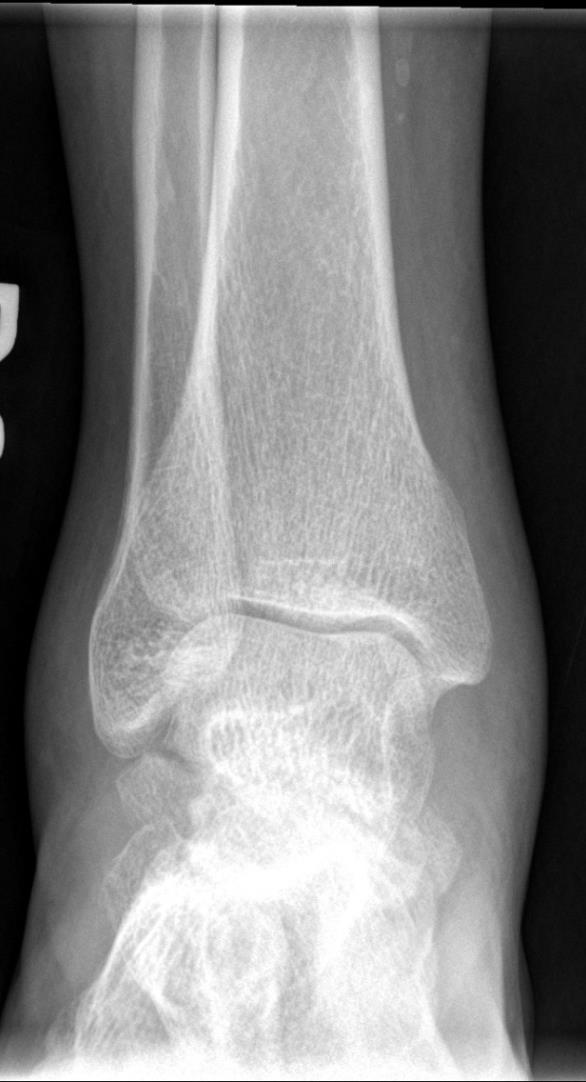 AP ankle Error ankle, too much of the is superimposed on the and the tibiotalar