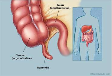 Diseases of the appendix