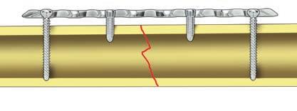 Important: If a combination of cortex (1) and locking screws (2) is used, a cortex screw should be inserted first to pull the plate to the bone.