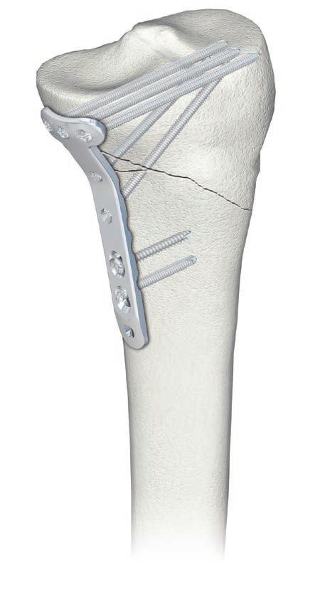 LCP Medial Proximal Tibial Plate 3.5. Part of the Synthes small fragment Locking Compression Plate (LCP) system. The LCP Medial Proximal Tibial Plate 3.