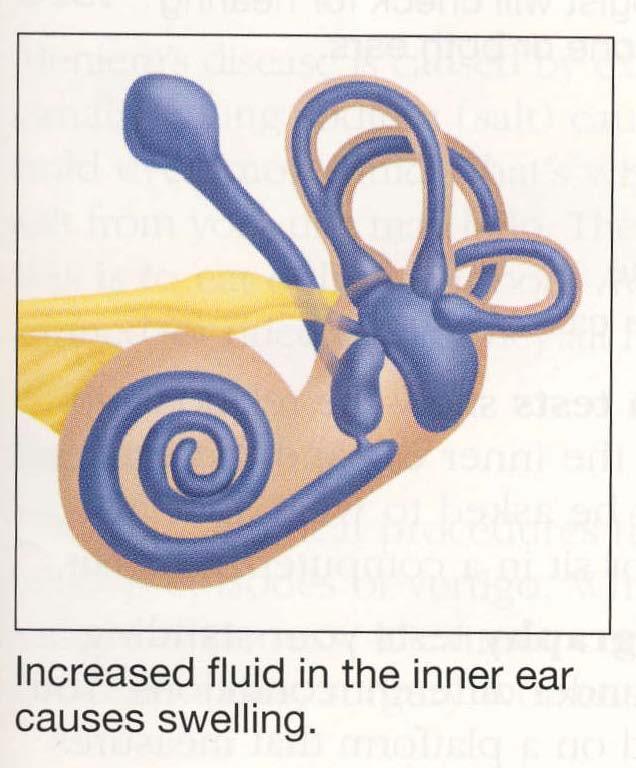 Meniere s Disease Results from Cochlea Hypertension Typical Meniere s disease: Causes episodes of vertigo that last hours Causes fluctuating unilateral hearing loss in