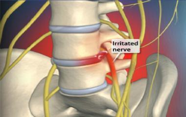 body. A nerve can become inflamed, resulting in pain locally or cause symptoms down the length