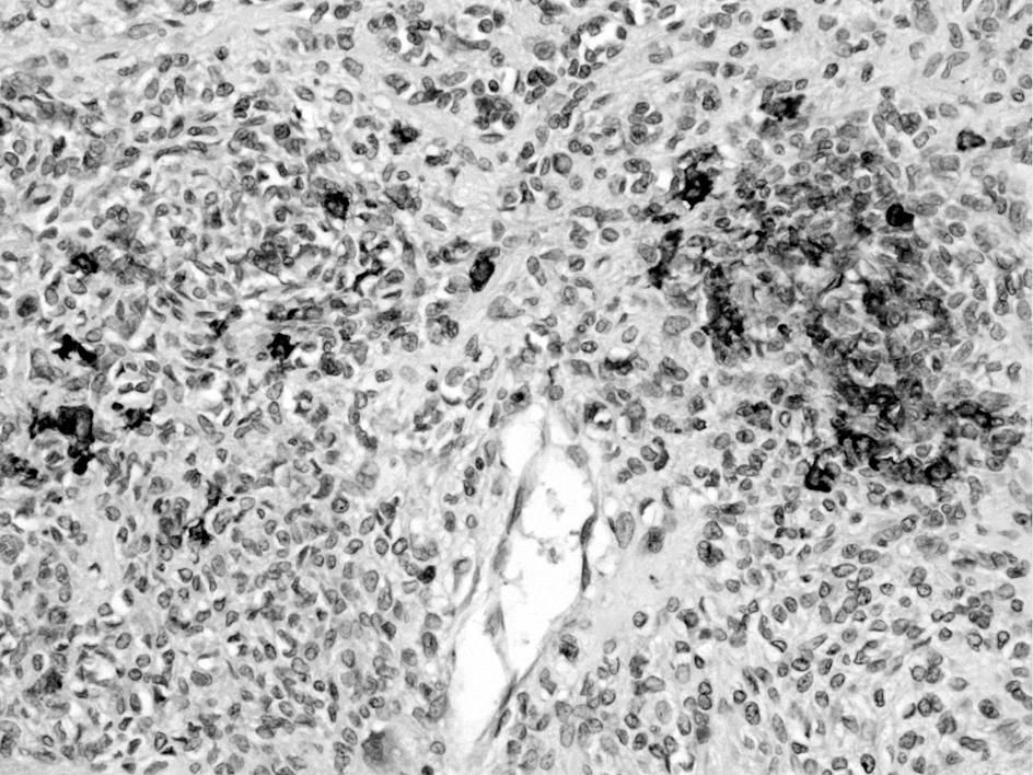 On the immunohistochemical stain, the tumor cells showed focal positivity for CD68, lysozyme, smooth muscle actin, desmin, CD99, and epithelial membrane
