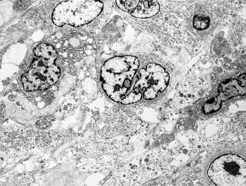 Many endoplasmic reticulum and phagolysosomes are present in the cytoplasm ( 2,000). S-100 protein, HMB-45, cytokeratin (AE1/ AE3), and CD34.