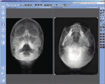 modality to cephalometric imaging. Optionally, the unit can be equipped with two fixed digital sensors.