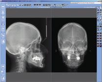 The digital cephalostat scans the patient s head horizontally with a narrow X-ray beam.