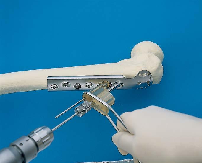 Surgical Technique Optional Additional Fixation Optional insertion of an antirotation screw using the DHS Parallel Drill Guide An antirotation screw may be inserted superior and parallel to the DHS