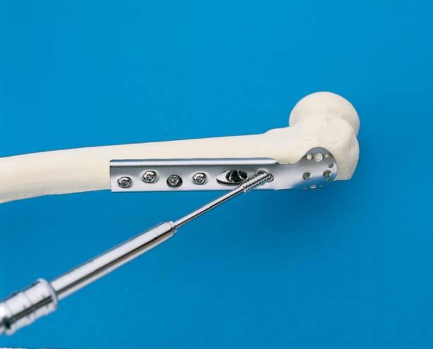 Surgical Technique Optional Additional Fixation 4 Insert appropriate sleeve as indicated below Antirotation Screw Type Instrument 7.0 mm Cannulated Screw 4.5 mm/2.0 mm Insert Wire Sleeve (388.720*) 6.