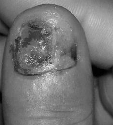 Vol. 12 No. 2, December 2004 Squamous cell carcinoma of the nail bed 251 Figure 7 An inflamed, necrotic, and discharging lesion lay over the radial side of the nail bed of the right thumb in case 3.