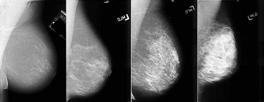 BREAST DENSITY SCORE Density score is based on the proportion of fatty and fibroglandular tissue seen on mammogram A -The Breasts are almost entirely fatty (prevalence 10%) B - There are scattered