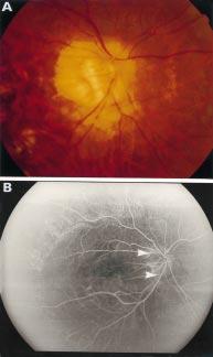(B) The arterial phase of fundus fluorescein angiography shows the concentric shape of the circle of Zinn Haller (between arrowheads) at the temporal aspect of the tilted disc.