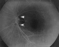 Peripapillary circle of Zinn Haller revealed by fundus fluorescein angiography 667 Figure 10 The left eye of patient 12 with a refraction of 8.50 dioptres.