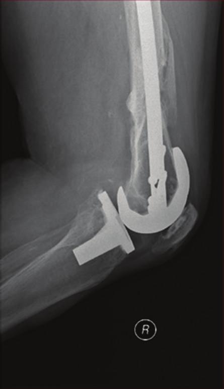 Case Reports in Orthopedics 3 Figure 6: 24 months of postoperative AP and lateral right knee X- rays showing complete consolidation of the fracture.