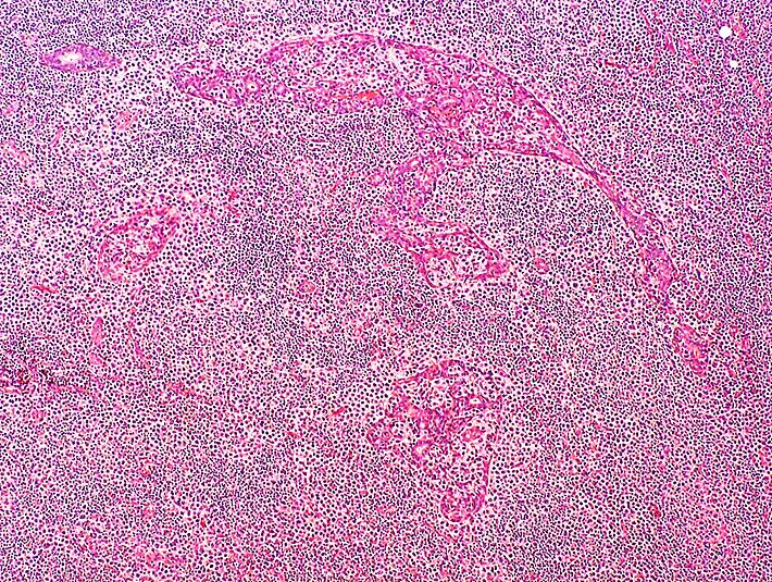 Figure 8. Effacement of the salivary gland parenchyma by epitheliotrophic lymphoid tissue. Limited residual gland parenchyma is noted (arrow). Hematoxylin and eosin (H&E) stain x40.