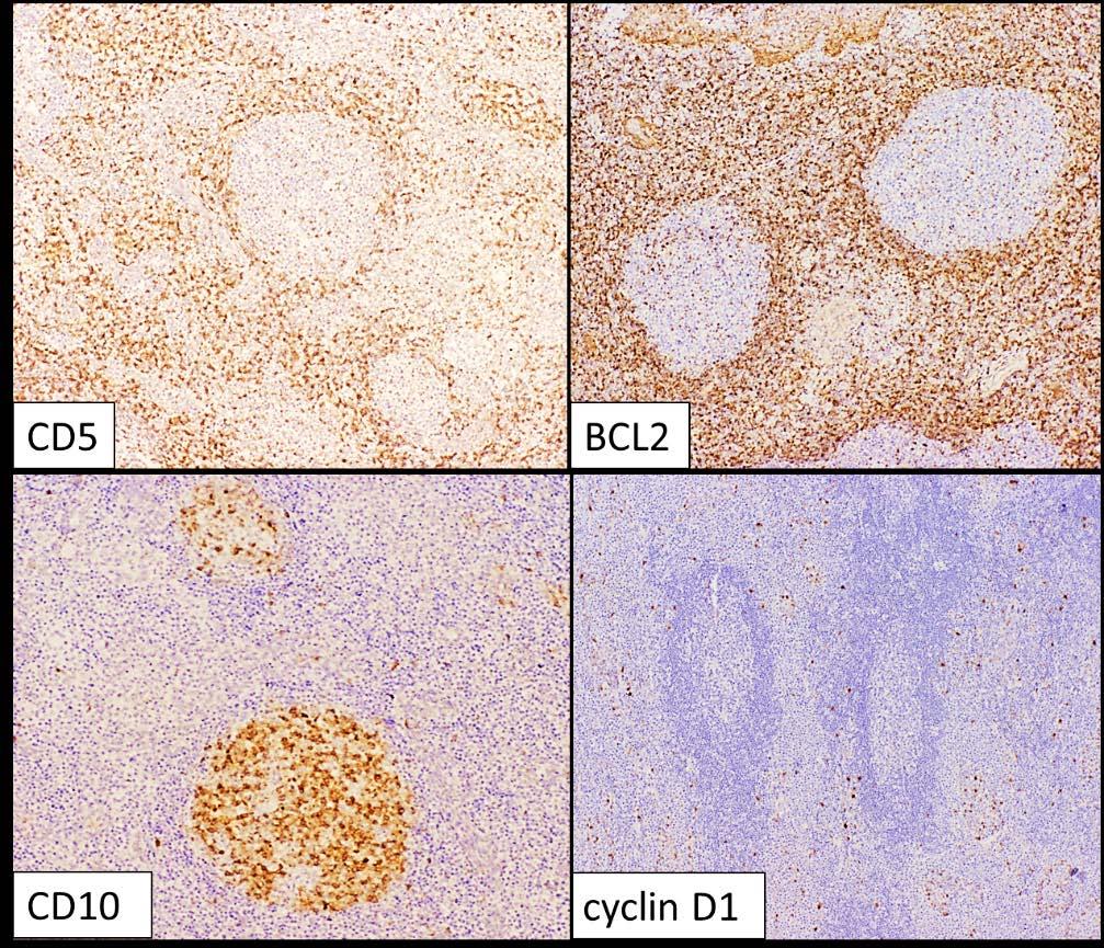 Figure 12. CD5 highlights background interfollicular cells only.