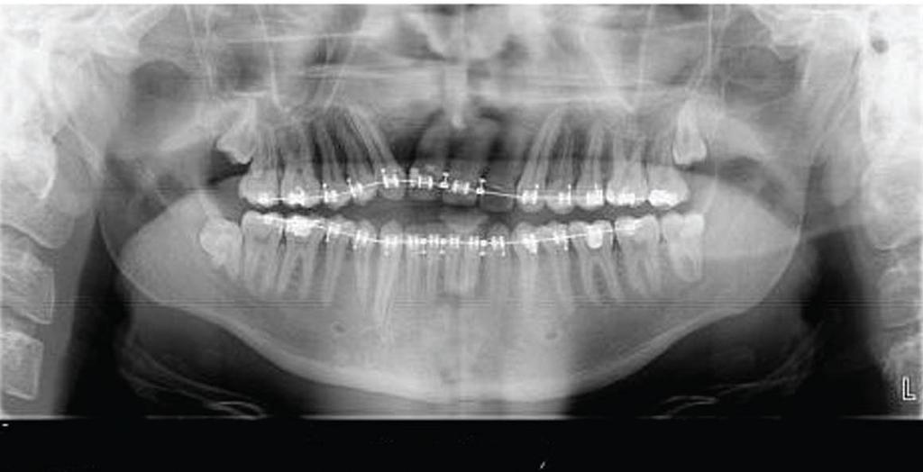 Post Treatment Review Two weeks post-surgery, the patient presented to the orthodontist with no overjet and the maxillary first premolars (now serving as the canines) in a Cl III relationship (Figure
