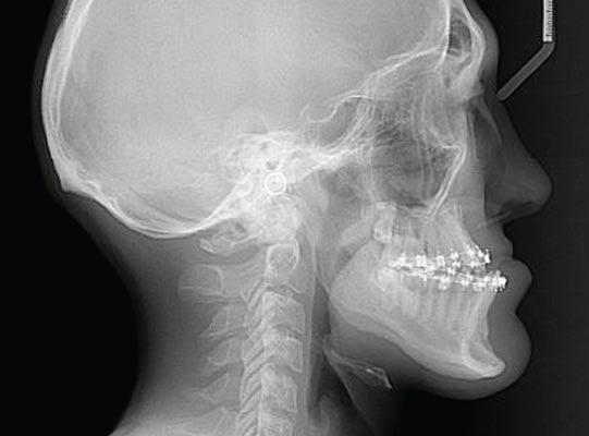 A midline correction loop was used to unilaterally close the space and move the maxillary midline towards the left (Figure 5). The RPGH was worn at night and Cl III elastics were used 24/7.