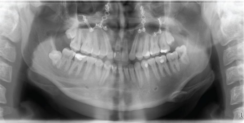 www.sada.co.za / SADJ Vol 72 No. 2 < 79 Figure 7: Final lateral cephalometric and panoramic radiographs. Note that the third molars are designated for extraction.