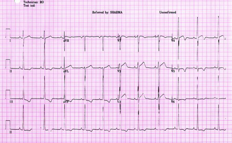 17 year old Swimmer Referred for Abnormal ECG Sees you for evaluation No syncope No symptoms of cardiac disease No FH of SCD Appears to be extremely physically fit