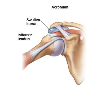 It is subject to the most pinching of all the rotator cuff muscles. Rotator cuff tears can be the result of a traumatic injury or deterioration over time.