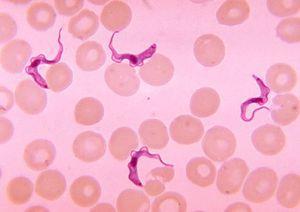 There is a sign known as Winterbottom s sign: it s a sign that s seen in the early stages of trypanosomiasis, when you may suspect the infection, the sign includes mainly the enlargement of the
