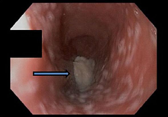 and poor lower esophageal sphincter relaxation (yellow arrow) compatible with type 2