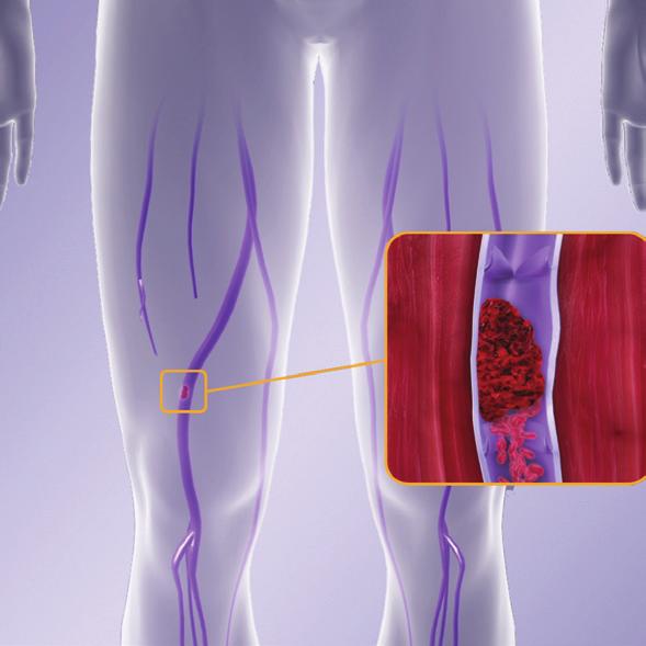 4 What are DVT and PE blood clots?? A deep vein thrombosis (DVT) is a blood clot that forms in a vein deep inside your body, such as in the legs.