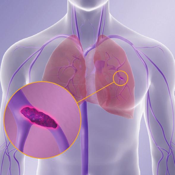 DVT PE DVT/PE 100,000 A pulmonary embolism (PE) occurs when a blood clot formed elsewhere in your body travels through the bloodstream and becomes lodged in your lungs.