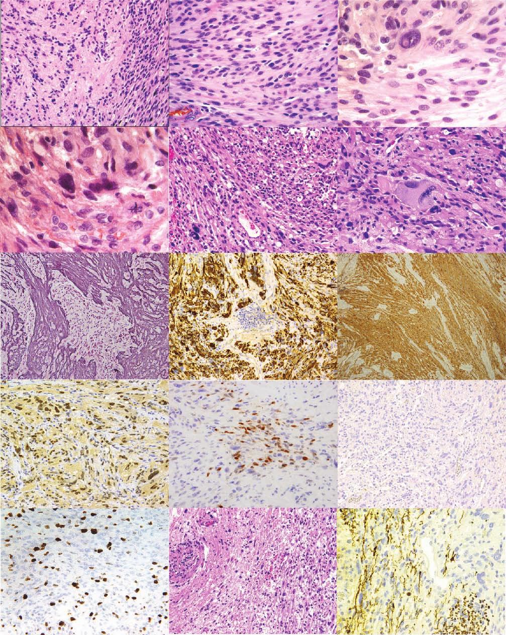 J Neuropathol Exp Neurol Volume 74, Number 10, October 2015 Primary Meningeal Pleomorphic Xanthoastrocytoma FIGURE 2. Histologic findings in Case 1. (A) Low-power photomicrograph of tumor (H&E stain).