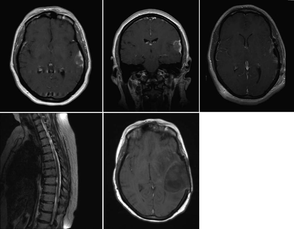 Usubalieva et al J Neuropathol Exp Neurol Volume 74, Number 10, October 2015 FIGURE 3. Case 2 neuroimaging.