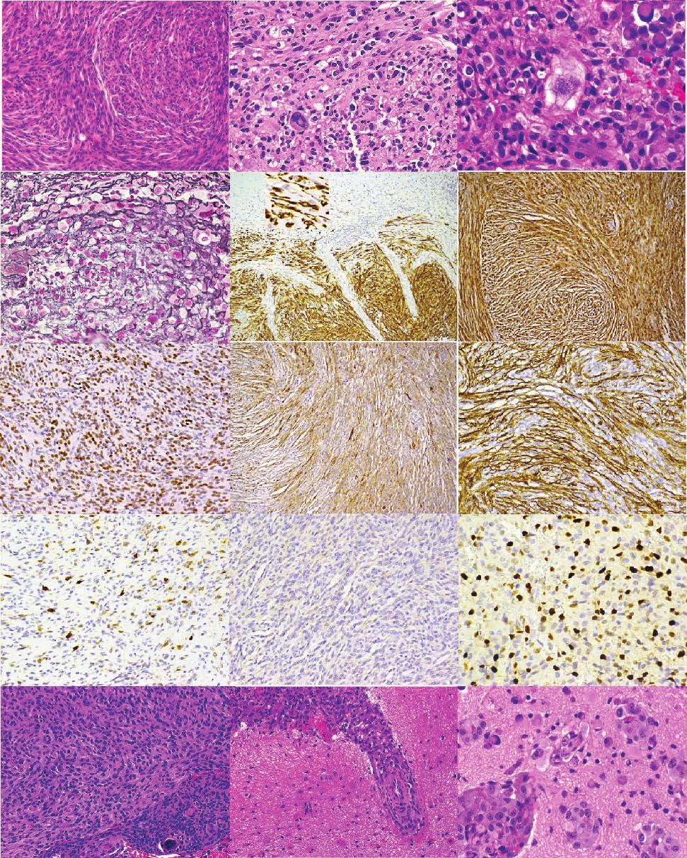 J Neuropathol Exp Neurol Volume 74, Number 10, October 2015 Primary Meningeal Pleomorphic Xanthoastrocytoma FIGURE 4. Histologic findings in Case 2.