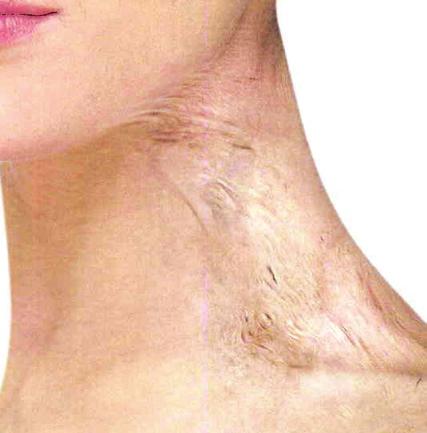 Scars occur when the skin receives a substantial wound produced by trauma or medical procedures.