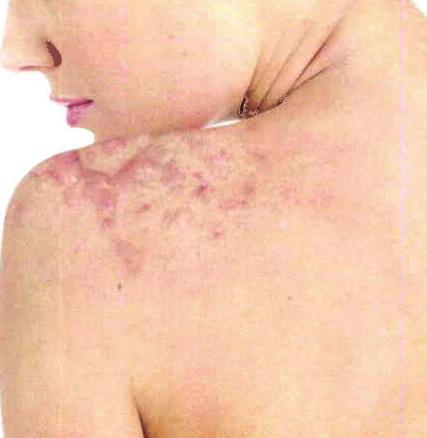 cuts Acne Scars Keloids Burn scar, mature Burn scars, active Scars left by esthetic accidents Scars