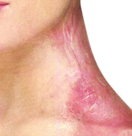 Cicatrization, or the formation of scars on the skin is most accurately described as the replacement
