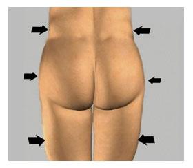 Post-op Unit 3: The area treated with liposuction may be strapped with elastic tape or a girdle will be applied.