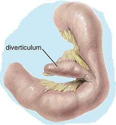 Meckel's diverticulum Remnant of the proximal part of the yolk stalk (vitelline duct), which extends into the umbilical cord in the embryo and lies on the antimesenteric border of