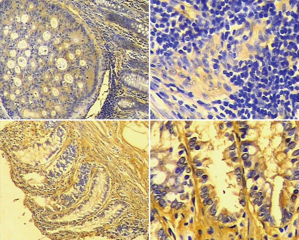 Sun GG et al. EMP1 and colorectal cancer A B C D Figure 1 Immunohistochemistry of epithelial membrane protein 1 protein in colorectal carcinoma and adjacent normal tissue.