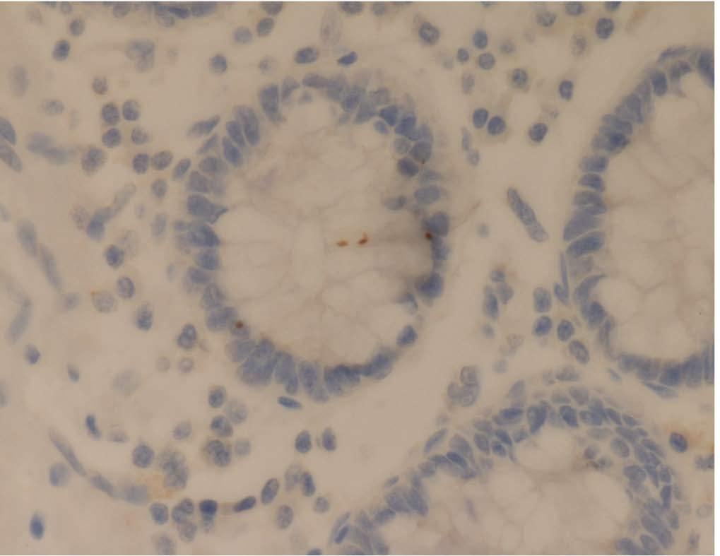 Hayes SJ et al. NY-ESO-1 expression in esophageal adenocarcinoma A B C D E F G H Figure 1 Immunohistochemistry images.