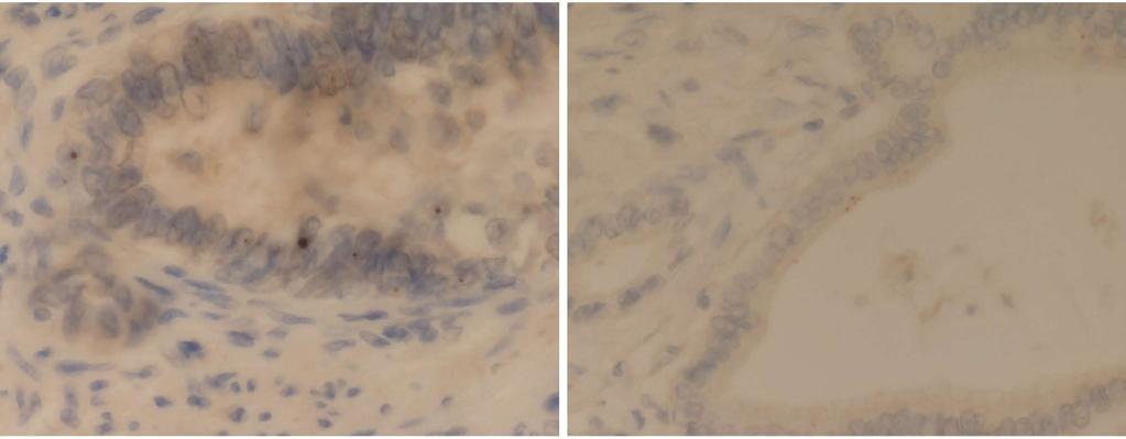 granular pattern of cytoplasmic NY-ESO-1 expression (IHC 40); C: Esophageal submucosal gland demonstrating dot-type expression for NY-ESO-1 (IHC 60); D: Barrett s esophagus